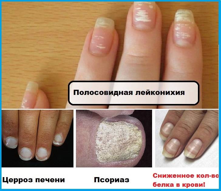 Ребристые ногти на руках у женщин - основные причины