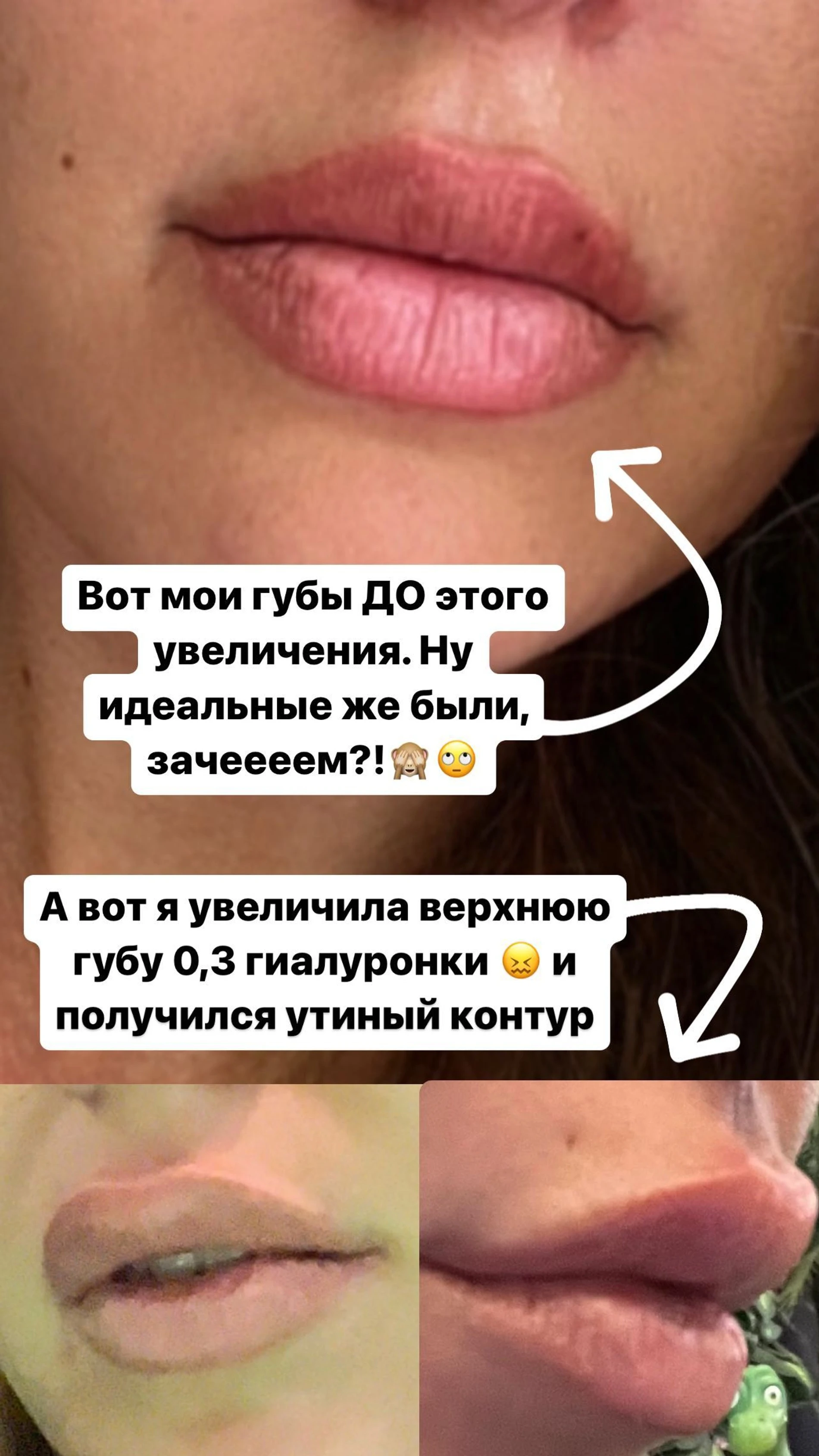 Пластика губ от "а" до "я"