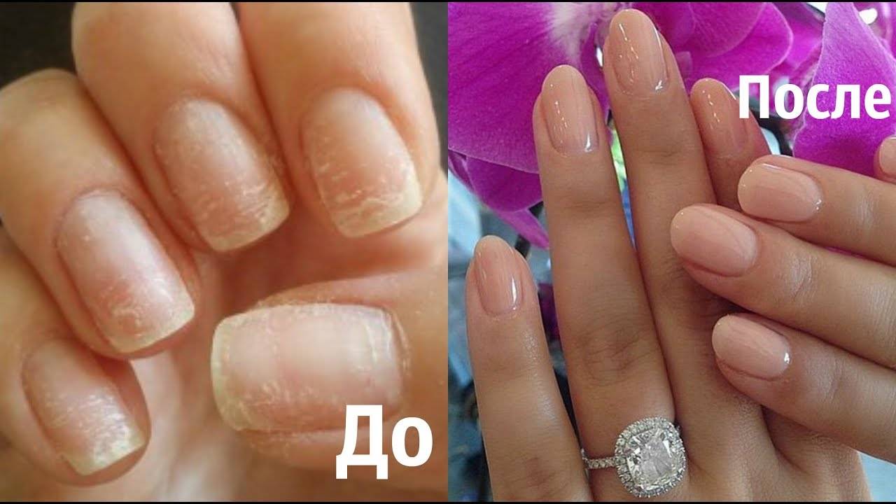 Быстрое восстановление ногтей после наращивания: процедуры в салоне; народные средства; ванночки и маски