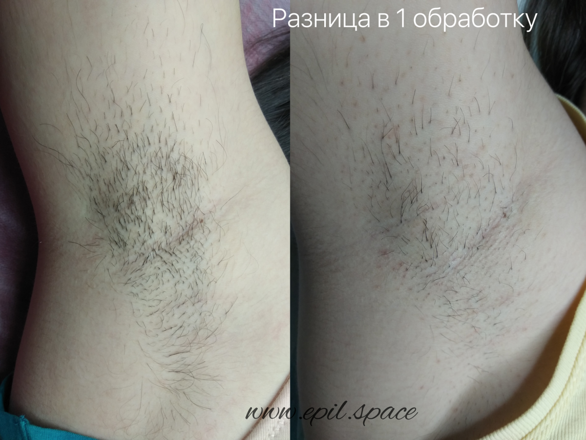 Электроэпиляция: как проходит, разновидности и противопоказания - 7дней.ру
