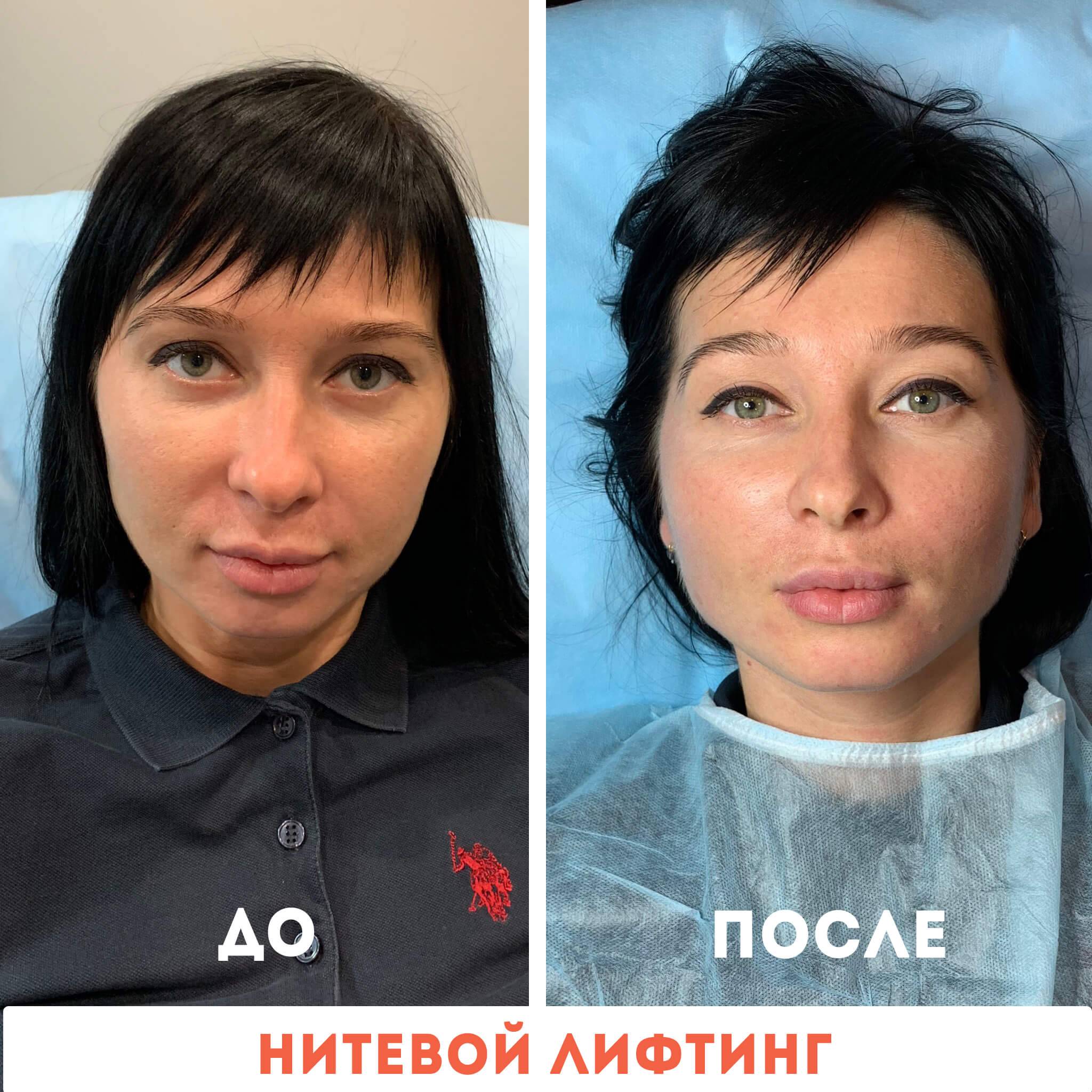 Нити для подтяжки лица: сколько мезонитей нужно, как происходит установка и пропадут ли шишки после процедуры? | moninomama.ru