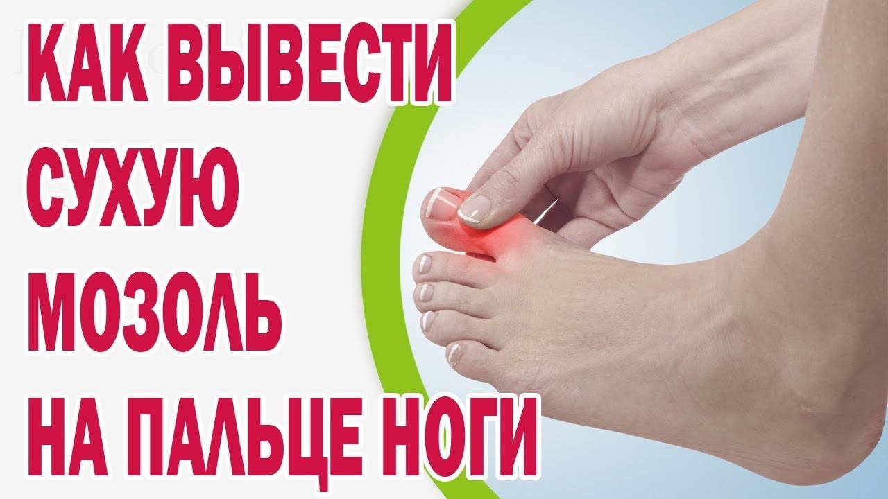 Мозоли на руках: причины появления, симптомы, признаки, лечение и диагностика. как избавиться и как лечить мозоли на руках народными средствами