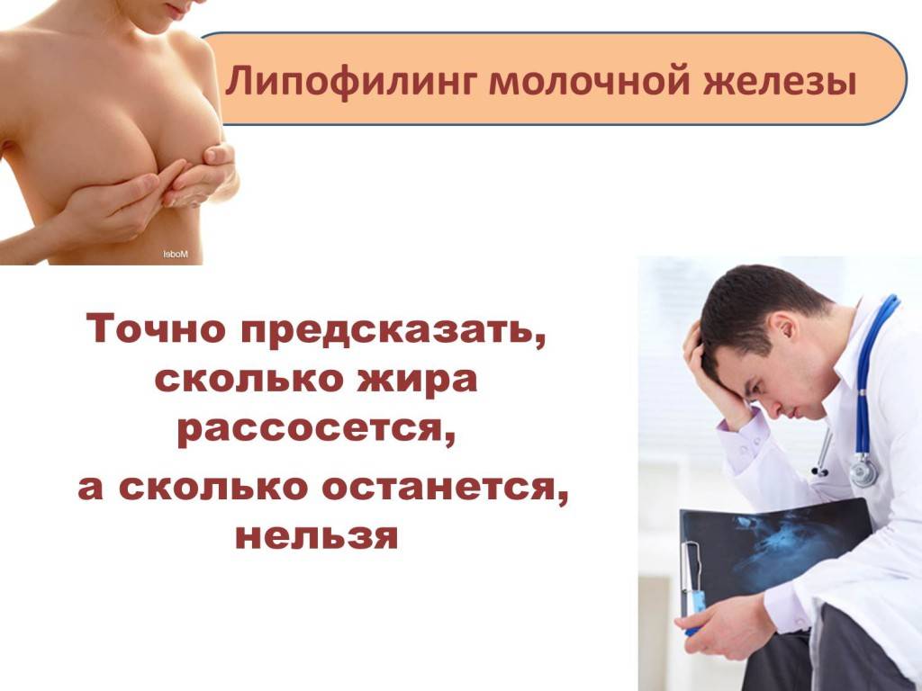 Липофилинг груди – это не альтернатива имплантации!