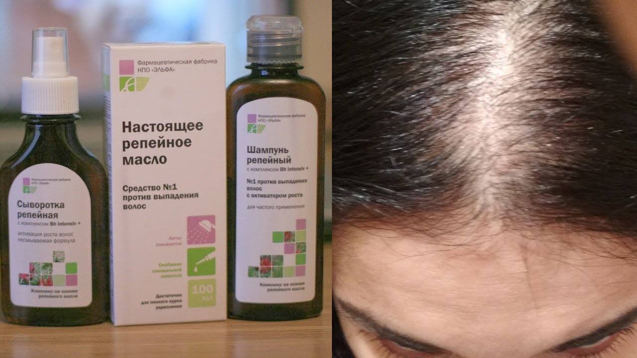Лечение алопеции (облысения) в домашних условиях– как убрать залысины на голове