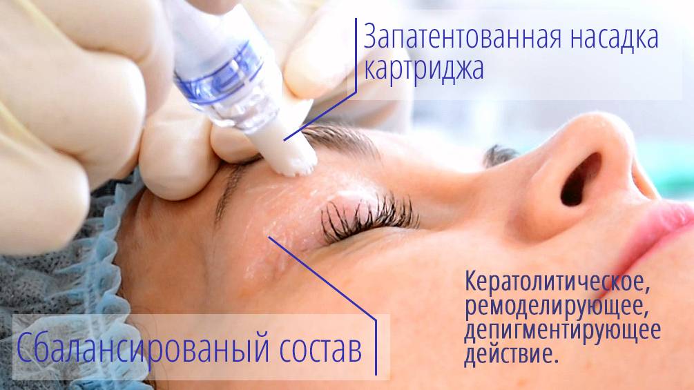 Поверхностные пилинги enerpeel - здоровье вашей кожи!