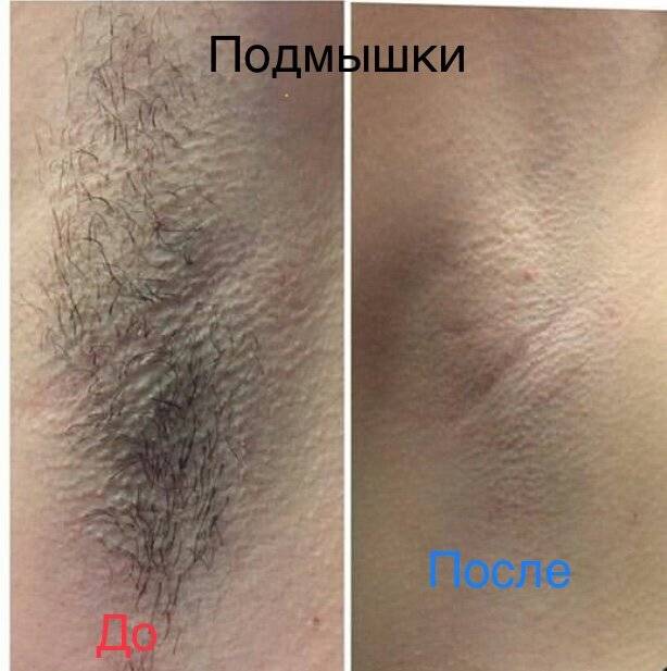 Электроэпиляция время и сеансы по зонам