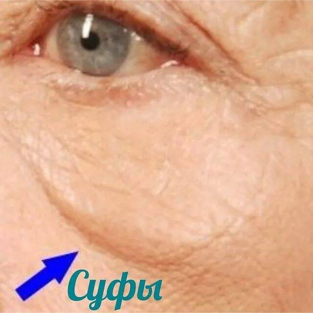 Почему появляются мешки под глазами? причины и лечение