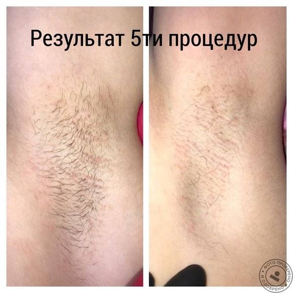 Последствия электроэпиляции о которых необходимо знать