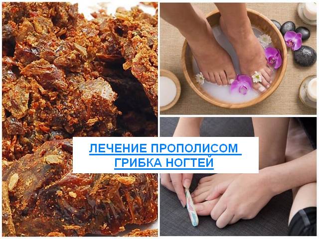 Прополис от грибка ногтей на ногах: лечение, рецепты ванночек, спиртовых настоек