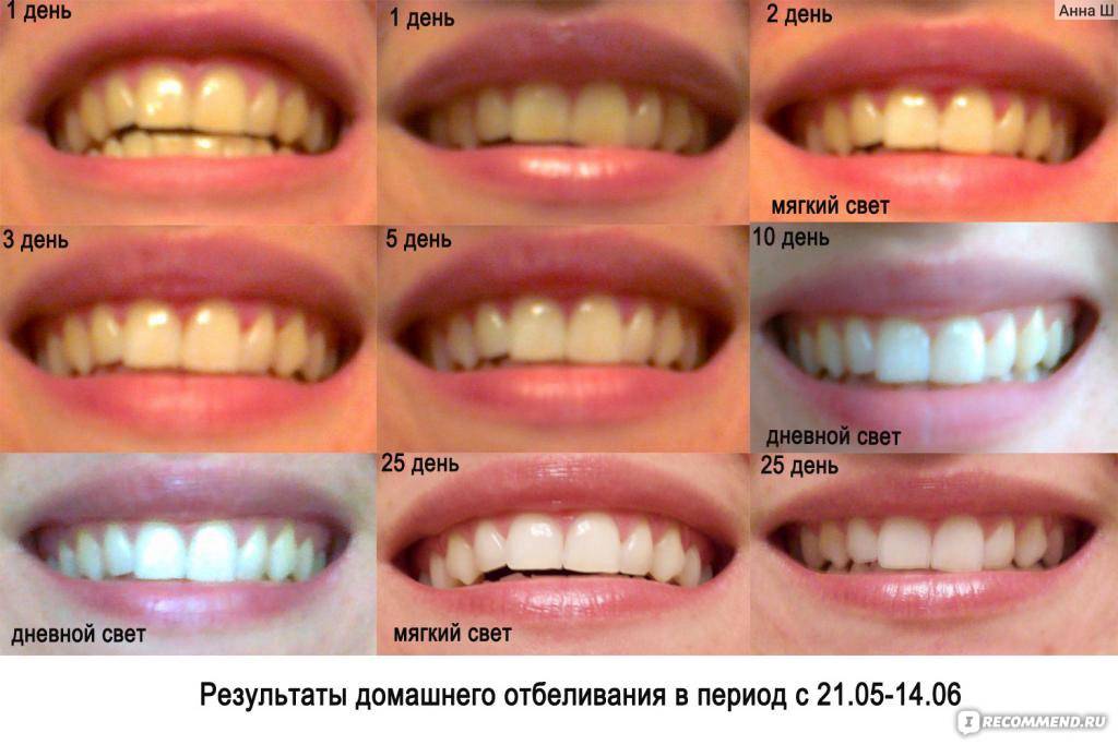 Как использовать капы для отбеливания зубов?