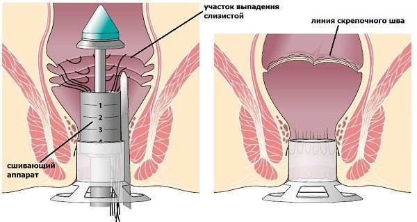 Широкое влагалище