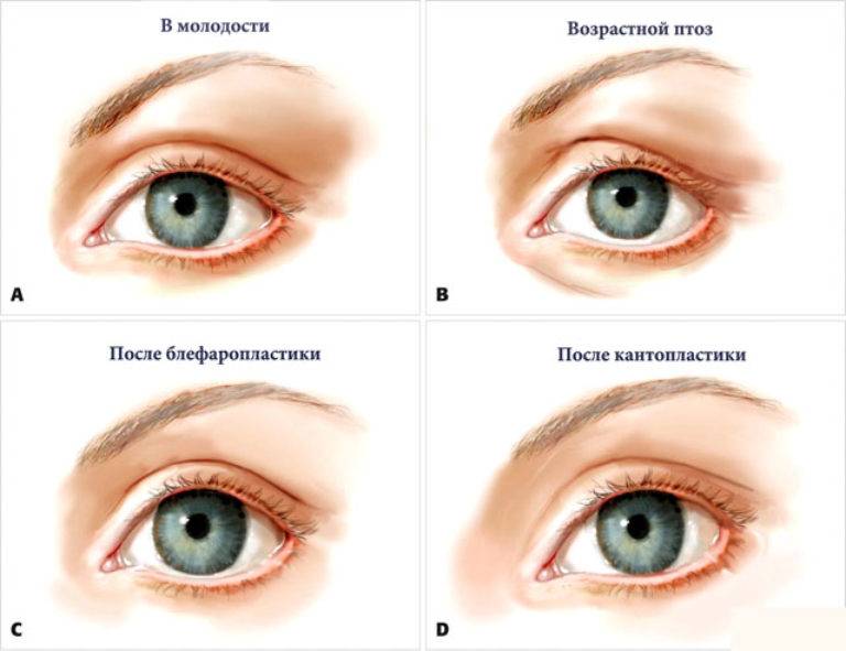 Блефаропластика с кантопексией - показания, отзывы, фото до и после операции