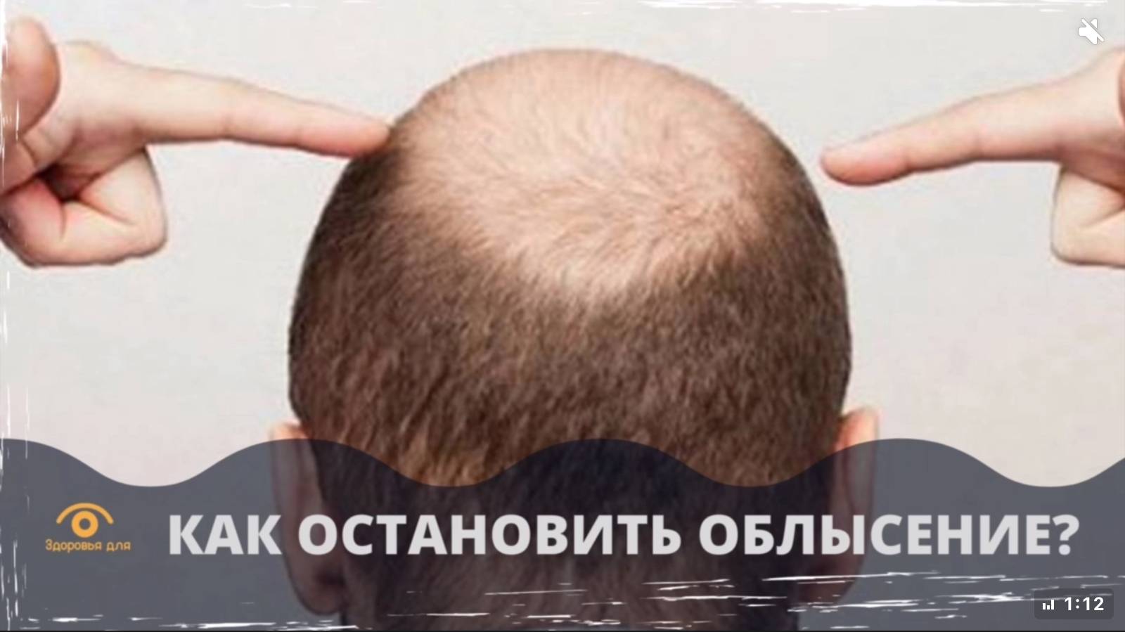 Причины выпадения волос у мужчин