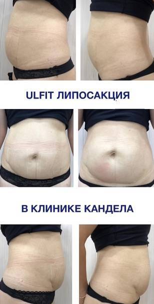 Ультразвуковая липосакция vaser: когда и как проводится, в чем отличия от других методов липосакции