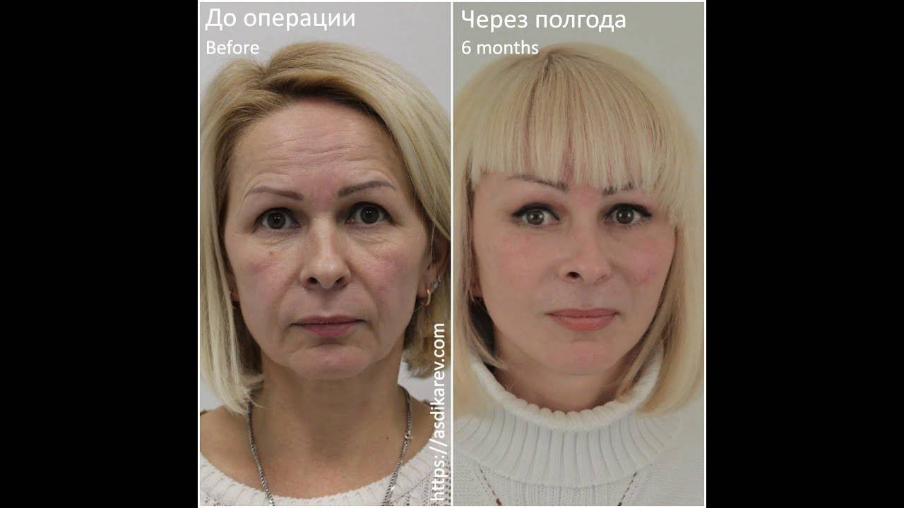 Круговая подтяжка лица: как проходит операция, отзывы, видео, реабилитация, фото до и после