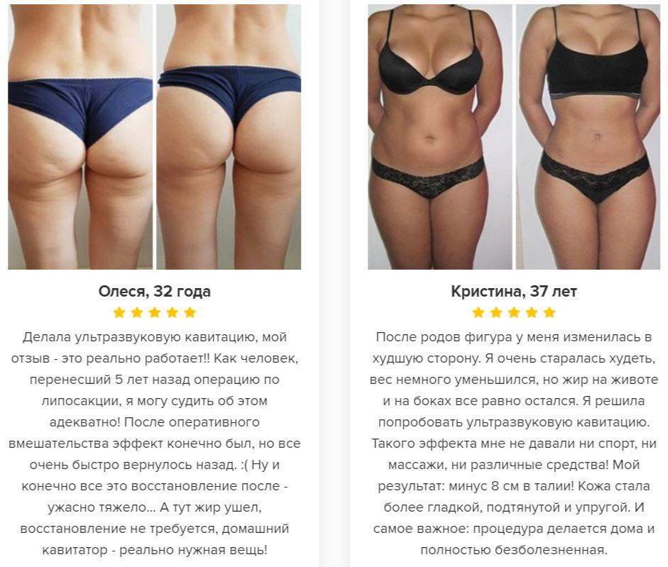 Ультразвуковая кавитация: процедура безоперационной липосакции - allslim.ru