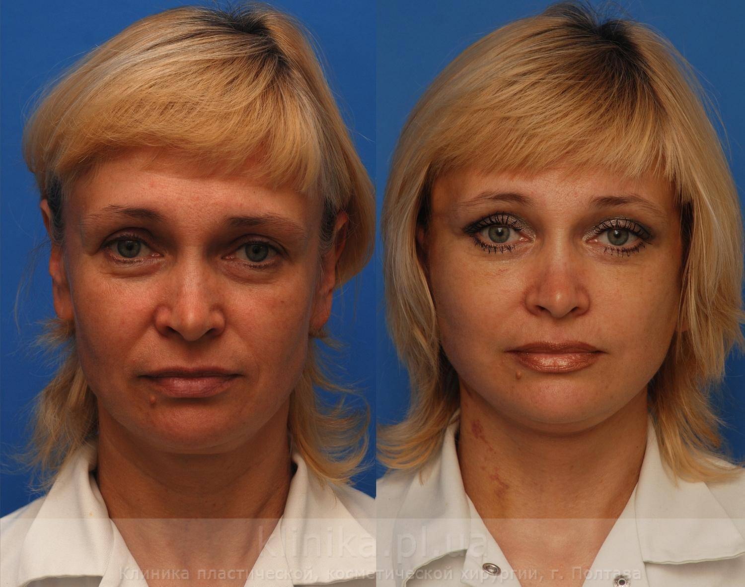 Пластика лица
