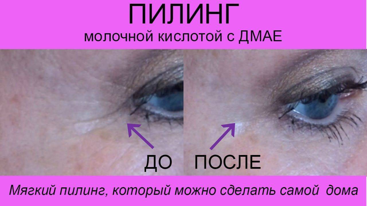 Молочный пилинг в домашних условиях: показания, инструкция, рецепт