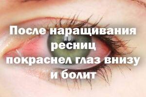 Покраснение глаз после наращивания ресниц – причины и способы устранения