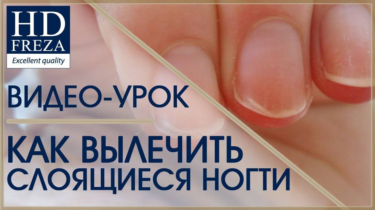 Слоятся ногти — что делать? причины и лечение в домашних условиях