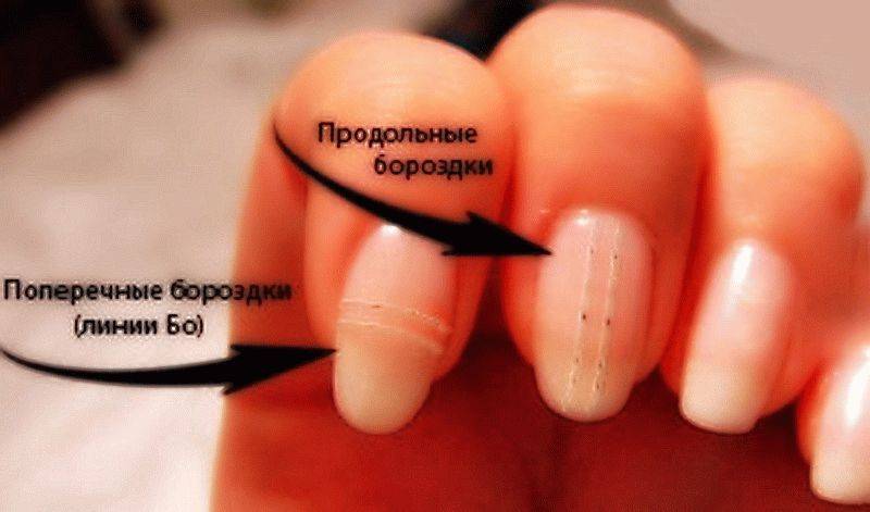 Почему на ногтях появляются бороздки и как это лечить