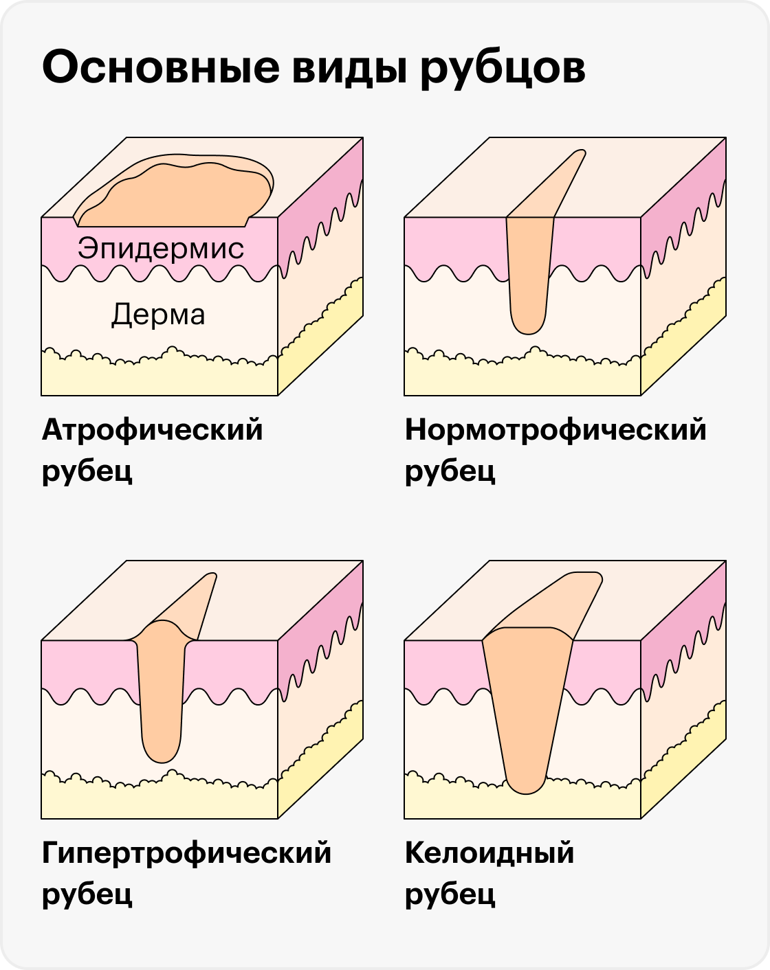 Как лучше всего избавляться от старых шрамов и рубцов (более 6 мес.)