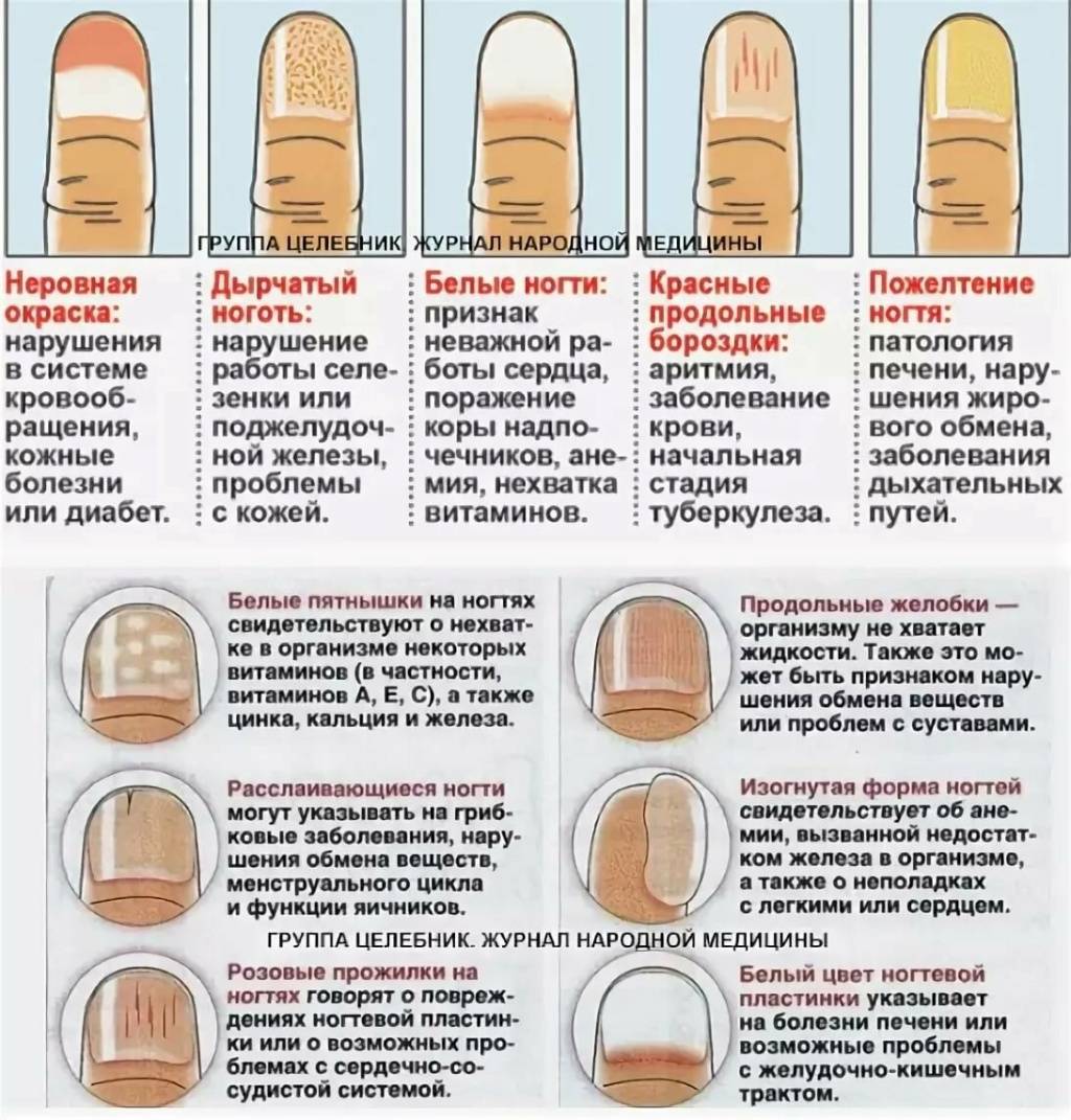 Расслоение ногтей лечение