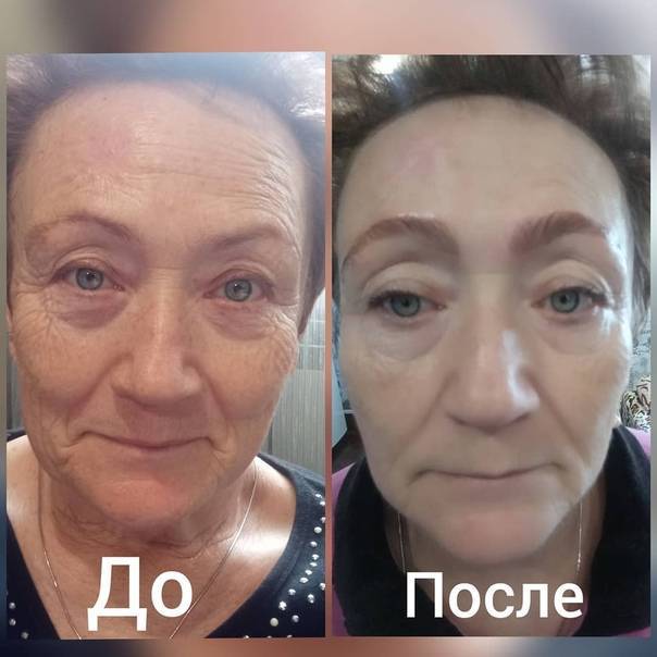 Мезоботокс - mesobotox