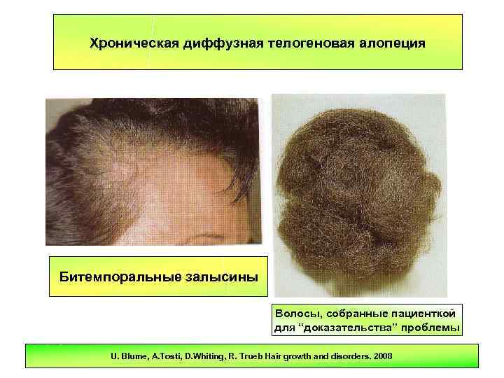 Диффузная алопеция у женщин – причины выпадения волос и лечение