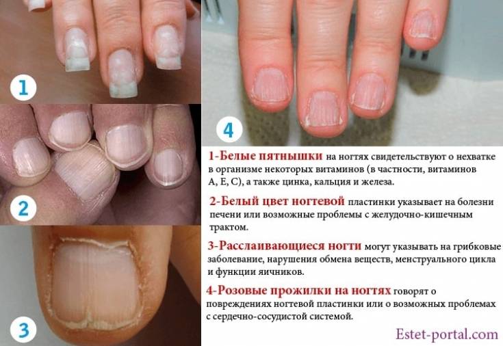 Отслаиваются ногти у основания: необходимы срочные меры!