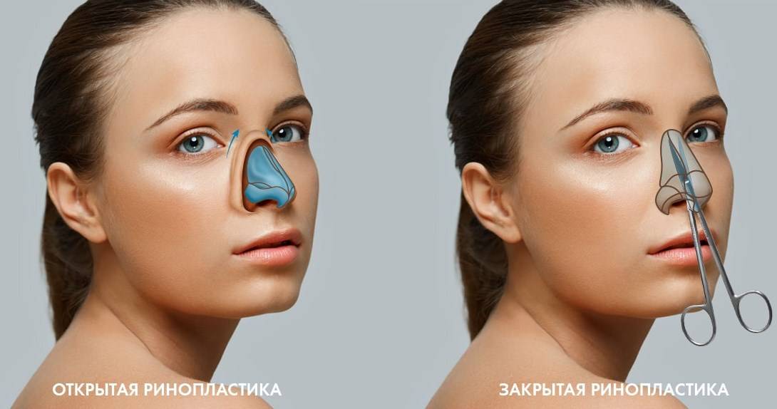 Ринопластика сегодня - виды, показания, этапы пластики носа и последствия