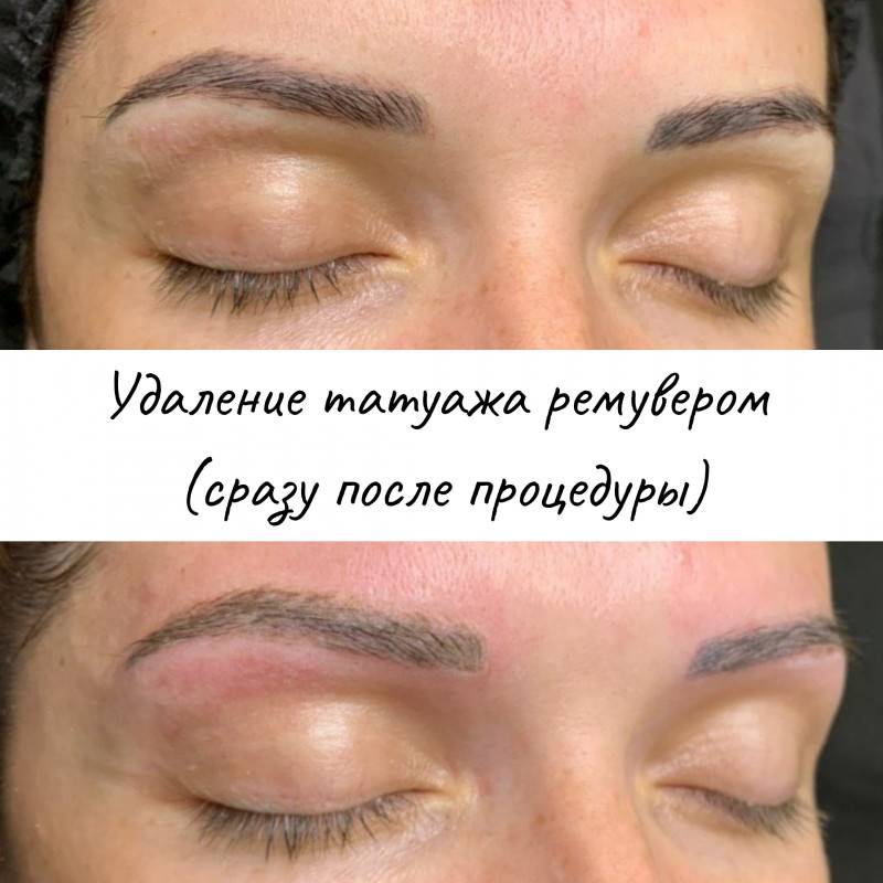Удаление татуажа бровей ремувером - отзывы, фото до и после