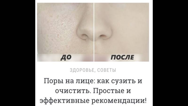 Расширенные поры: причины, способы борьбы, что делать
