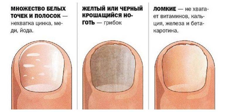 Пятна на ногтях: желтые, темные, коричневые, белые на большом пальце рук и ног: почему появились и что делать? | moninomama.ru