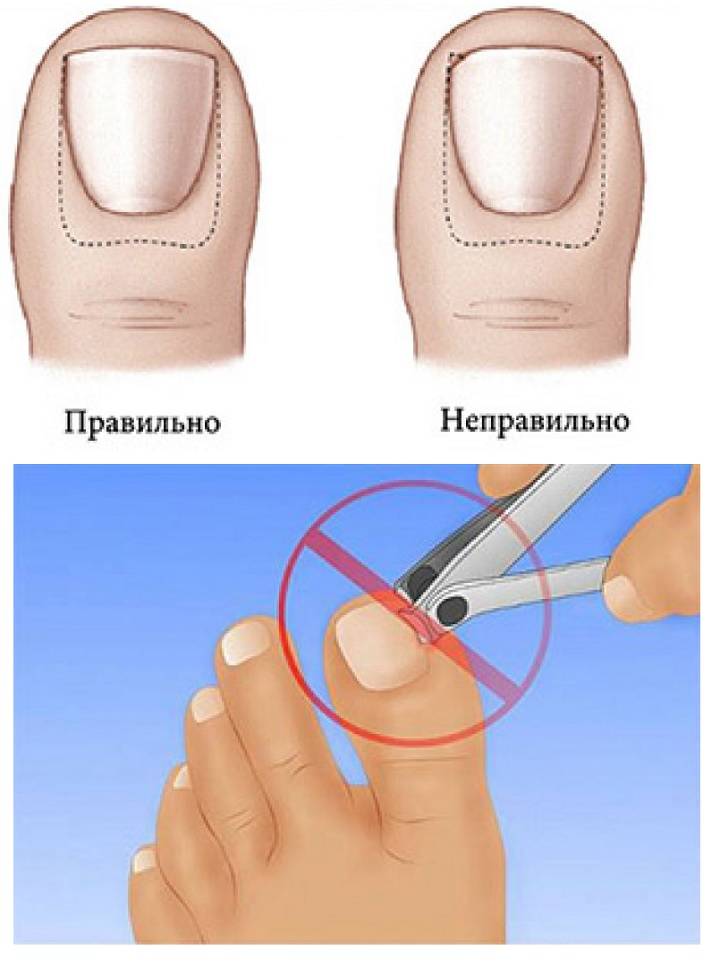 Вросший ноготь на ноге: причины, лечение, симптомы, удаление, операция | азбука здоровья