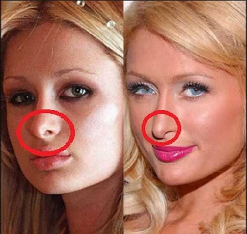Paris hilton plastic surgery journey - vanity