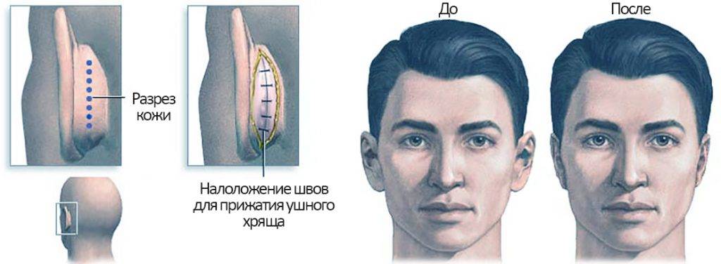 Отопластика (пластика ушей)