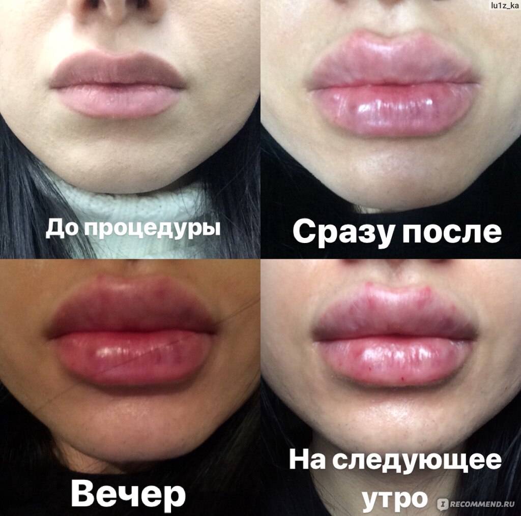 Как ухаживать за губами после увеличения? советы для ухода после пластики или инъекционного увеличения