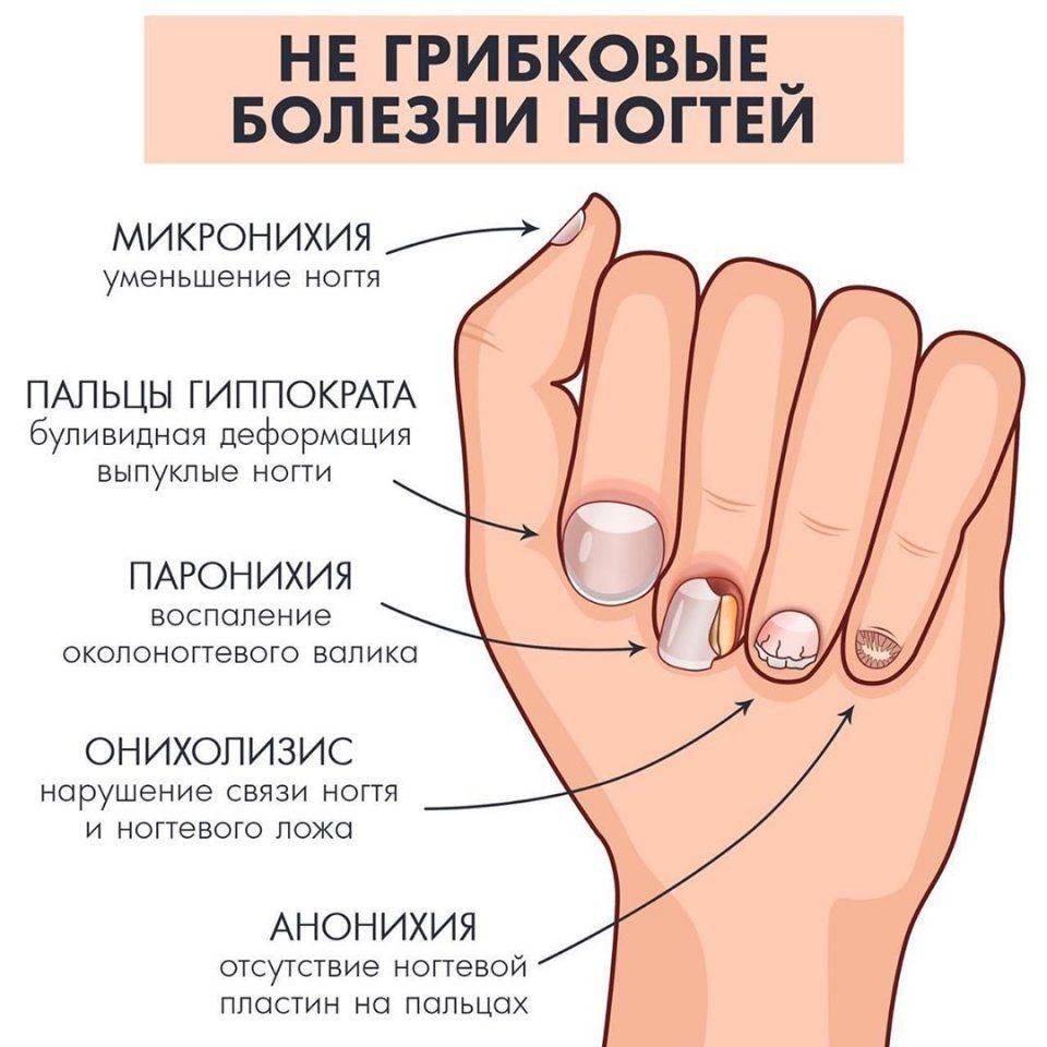 Что значат большие лунки на ногтях. лунки на ногтях — что они означают для здоровья человека