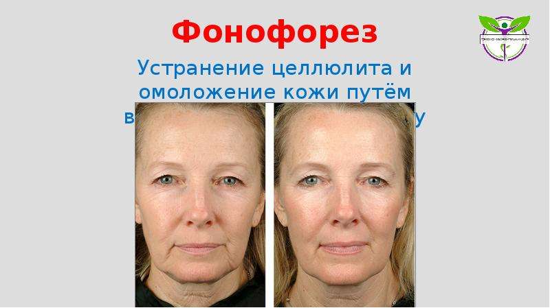 Фонофорез для лица: что это такое, описание процедуры, достоинства и недостатки