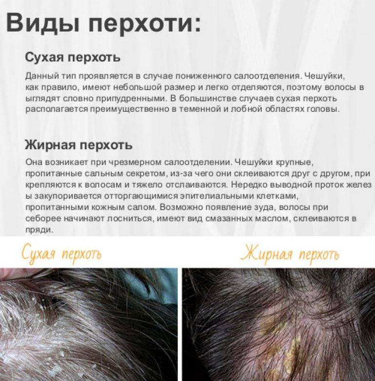 Причины перхоти на голове у мужчин и женщин: почему появляется перхоть
