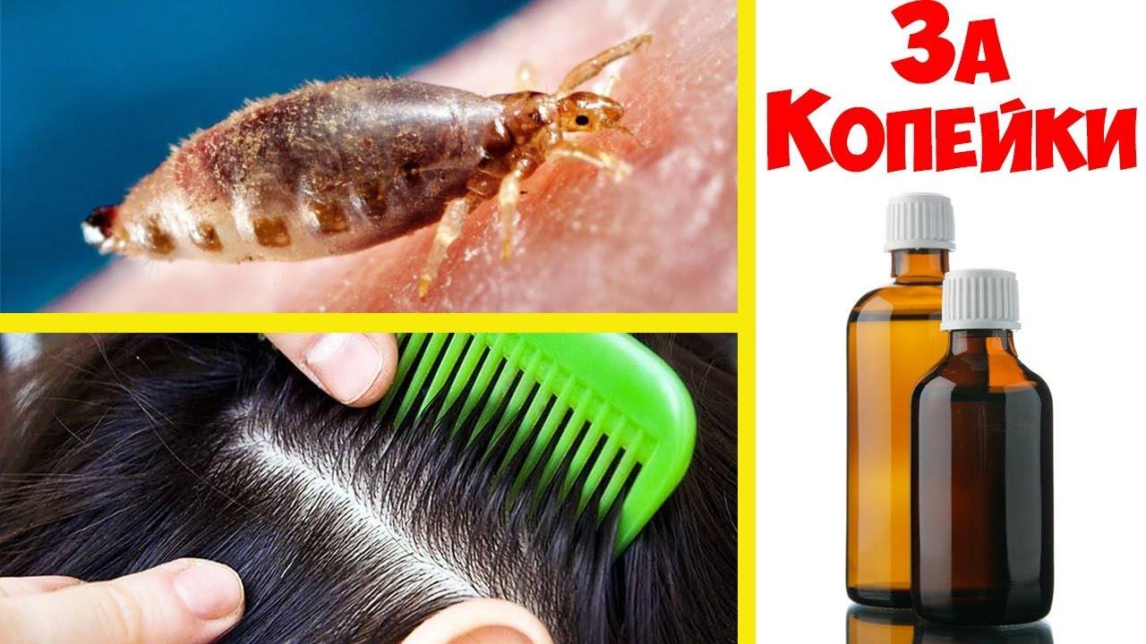 3 способа выведения вшей и гнид: химический механический комби