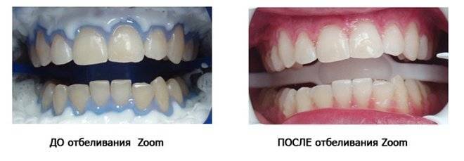 Что делать, если зубы здоровы? сделать их красивей! сделать отбеливание zoom | белые ночи | стоматологическая клиника в калининском районе санкт-петербурга