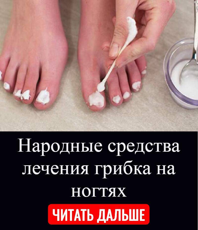 Лечение ногтевых грибков народными средствами: проверенные рецепты