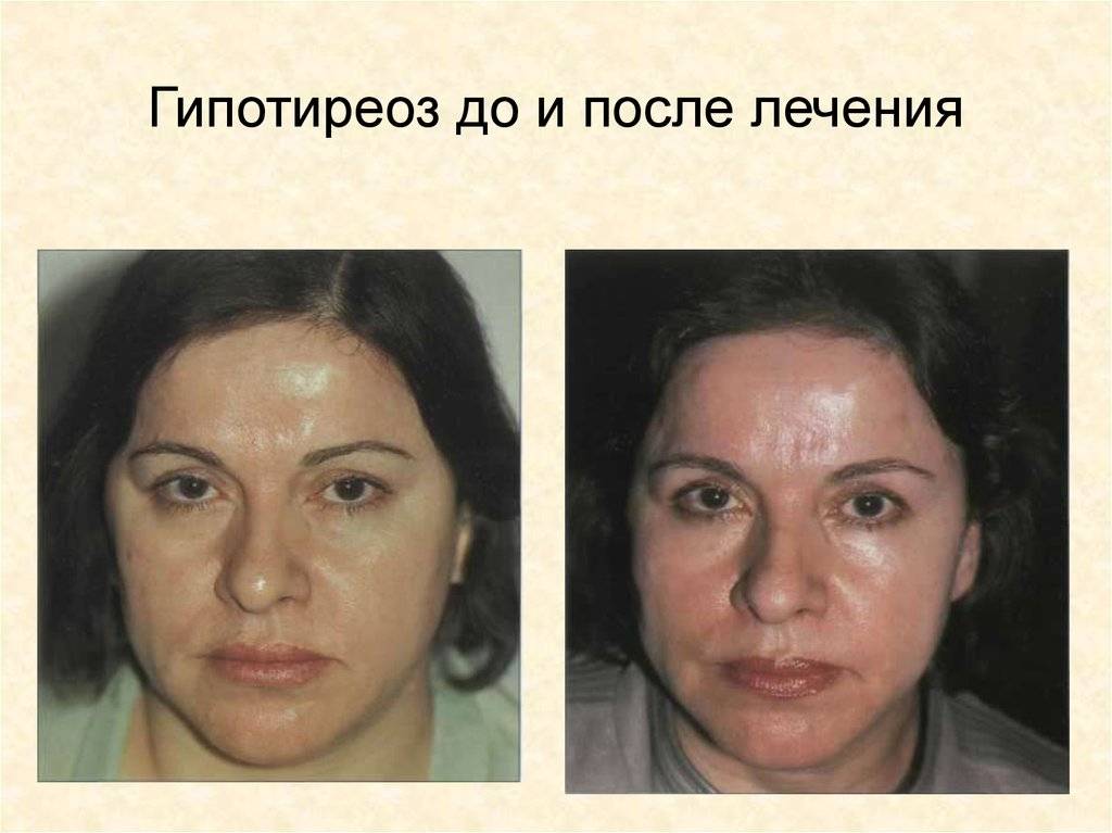 Как остановить выпадение волос при гипотиреозе?