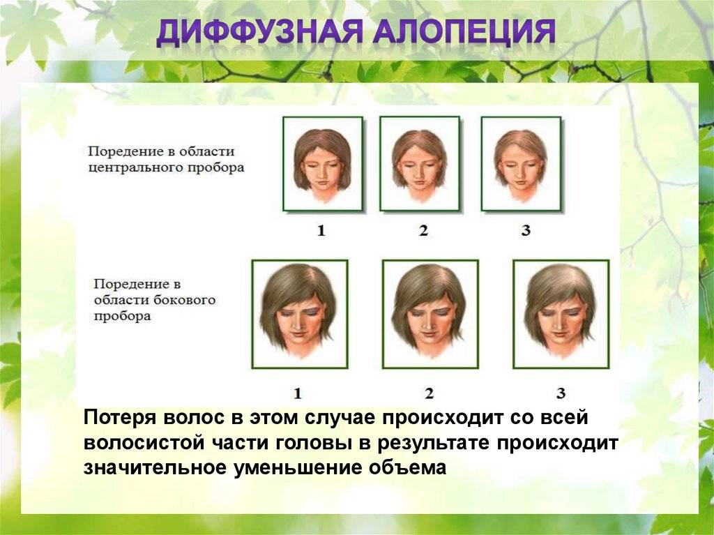 Диффузная алопеция у женщин и мужчин – причины и лечение телогеновой алопеции