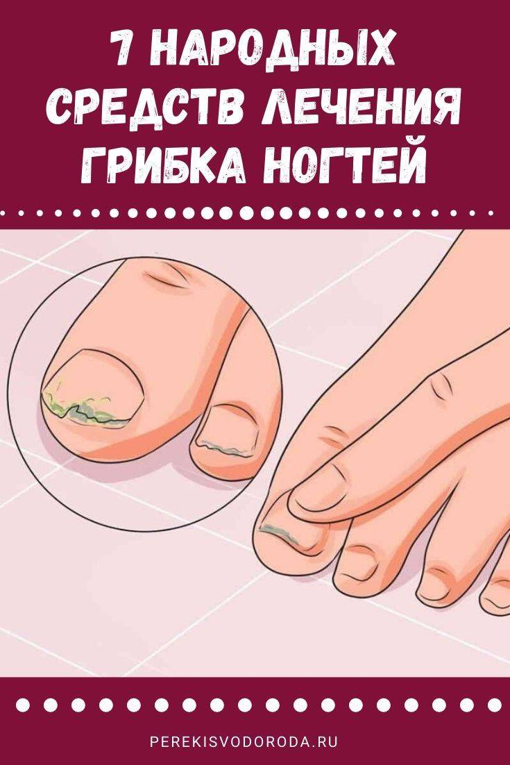 Лечение грибка ногтей народными средствами: самые эффективные