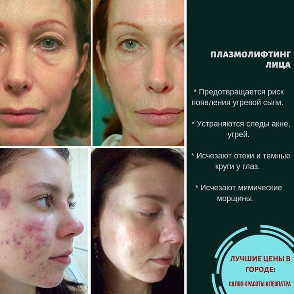Плазмолифтинг отзывы