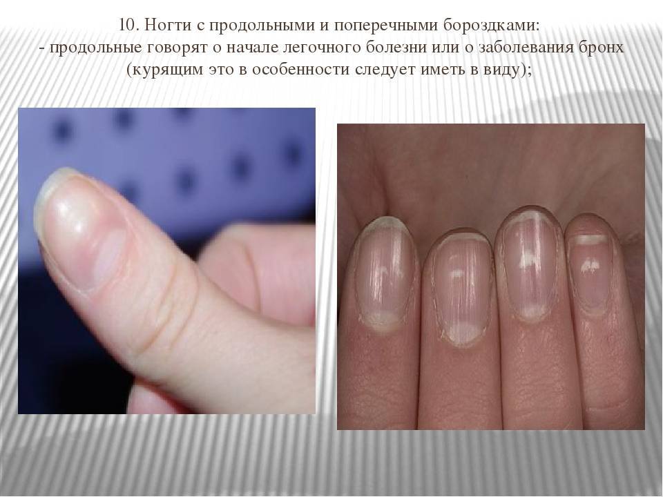 Волнистые и неровные ногти на руках: причины, лечение и препараты
