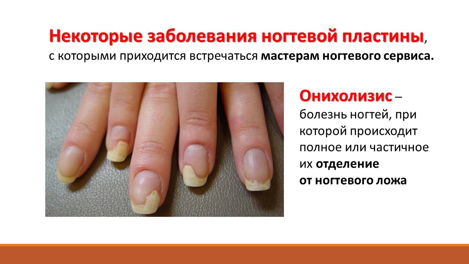 Как вылечить псориаз ногтей?